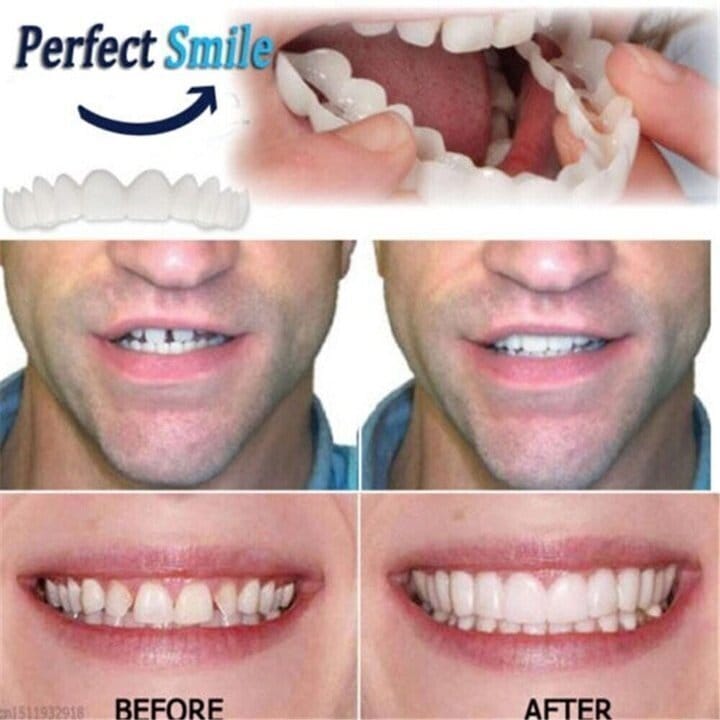 Last day discount-75%Off  Latest  Adjustable Snap-On Dentures